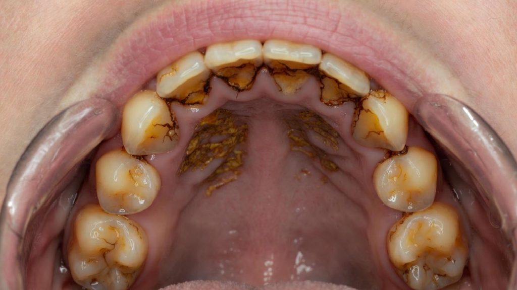 Diş Taşı İçin Porçöz Kullanılır mı?